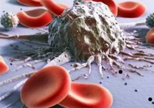 Лейкоз - злокачественное заболевание системы крови, характеризующиеся преобладанием процессов размножения клеток костного мозга, а иногда появлением патологических очагов кроветворения  Фото 1