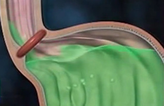 Желудочно - пищевой рефлюкс ( изжога ) представляет собой ощущение жжения за грудиной и в эпигастральной области, где и располагаются  Фото 1