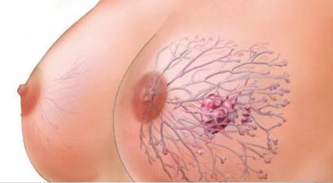 Рак молочной железы ( женской груди ) принадлежит к одной из самых частых форм рака у женщин, представляющий собой разрастание  Фото 1
