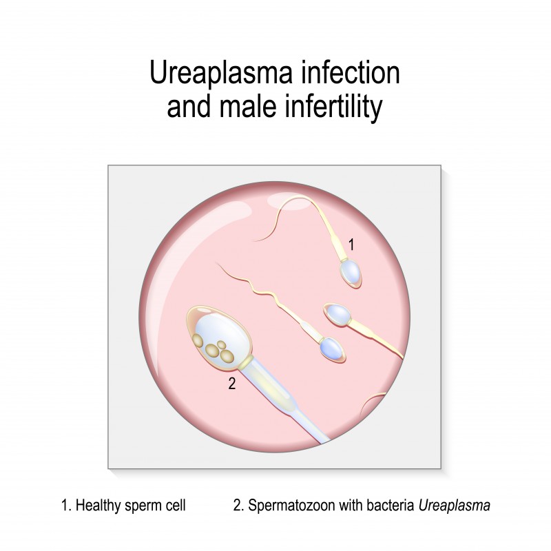 уреаплазма и спермотозоид